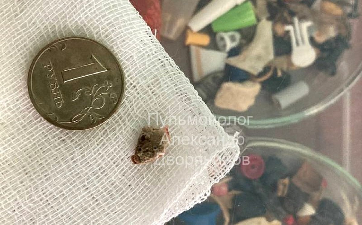 Ребенка с куриной костью в дыхательных путях спасли в Нижнем Новгороде