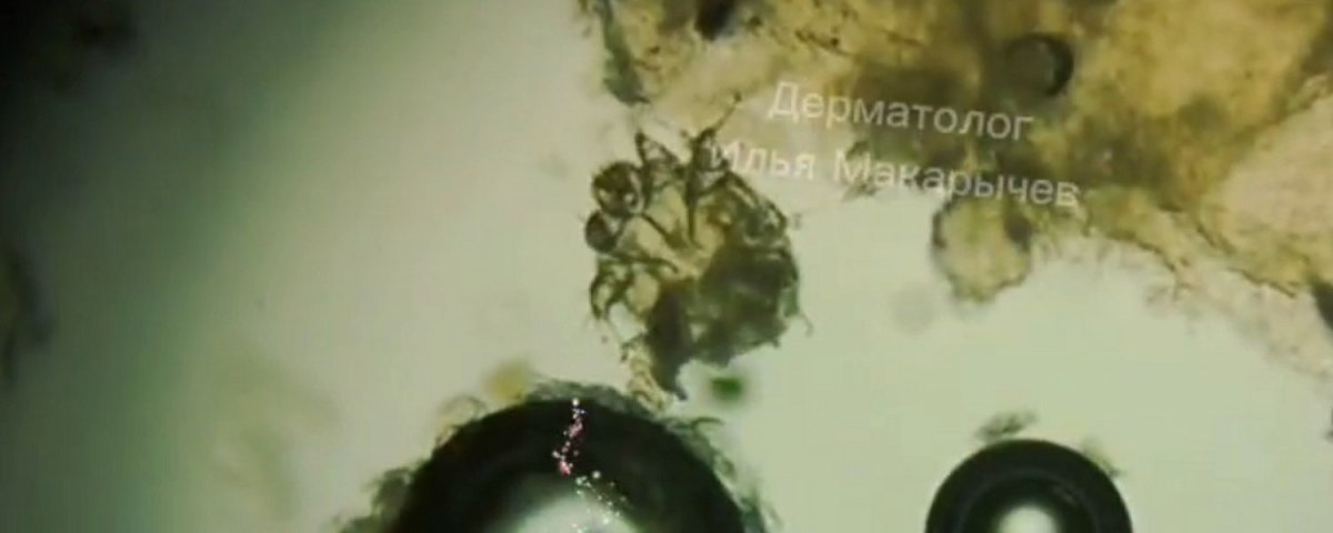 Нижегородцам показали, как выглядит чесоточный клещ под микроскопом